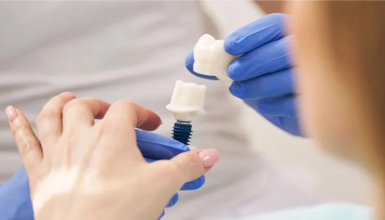Dental Implants Age